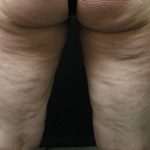 Cellulite Treatment Before & After Patient #1549