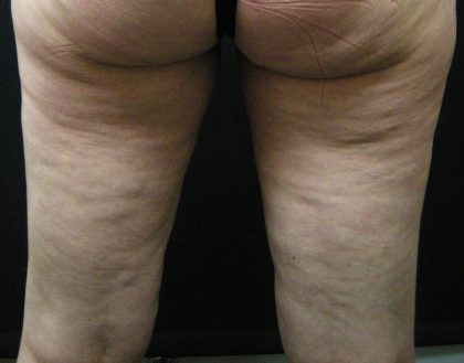 Cellulite Treatment Before & After Patient #1549