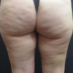 Cellulite Treatment Before & After Patient #1546