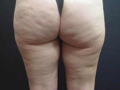 Cellulite Treatment Before & After Patient #1546