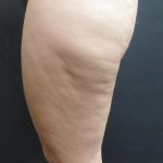 Cellulite Treatment Before & After Patient #1543
