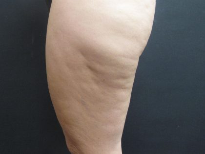 Cellulite Treatment Before & After Patient #1543