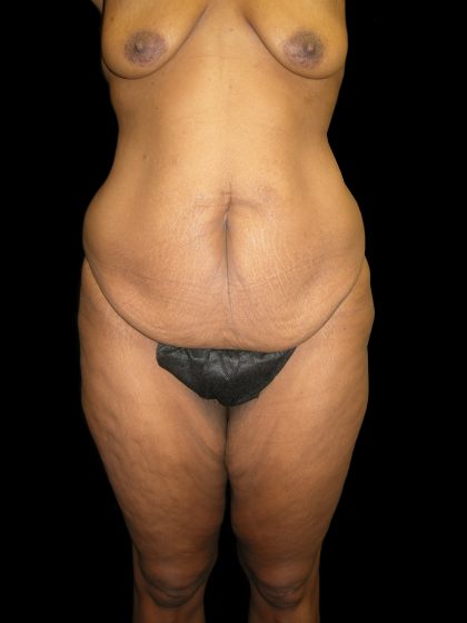 Lower Body Lift Before & After Patient #2327