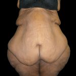 Lower Body Lift Before & After Patient #2294