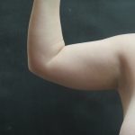 Liposuction Before & After Patient #936