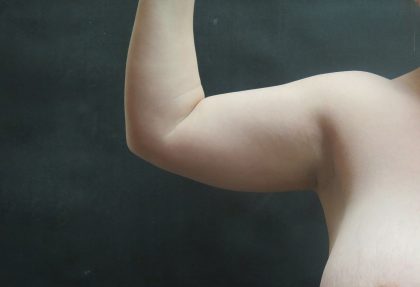 Liposuction Before & After Patient #936