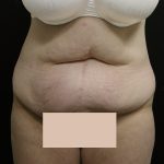 Lower Body Lift Before & After Patient #2285