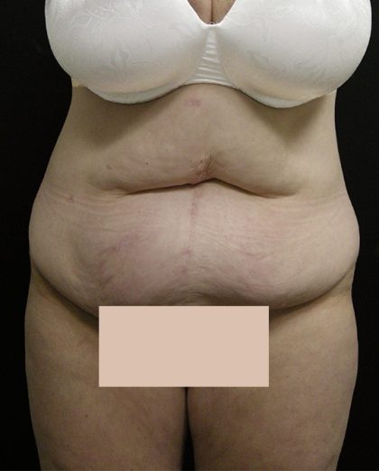 Lower Body Lift Before & After Patient #2285