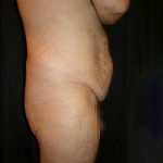 Lower Body Lift Before & After Patient #2269
