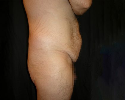 Lower Body Lift Before & After Patient #2269
