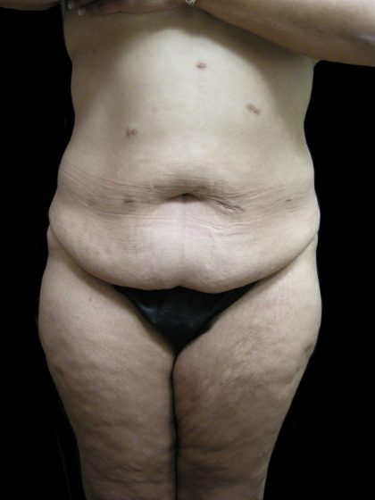 Lower Body Lift Before & After Patient #2316