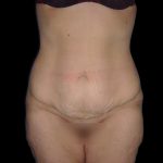 Lower Body Lift Before & After Patient #2278