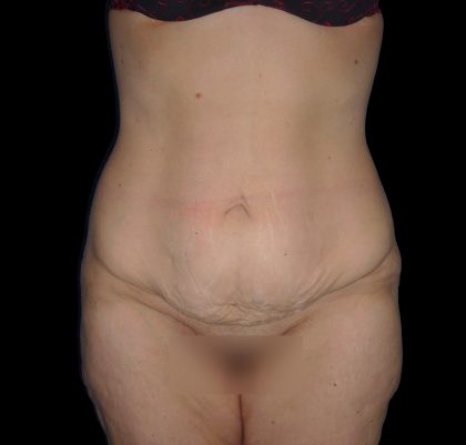 Lower Body Lift Before & After Patient #2278