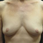 Inverted Nipple Correction Before & After Patient #1872