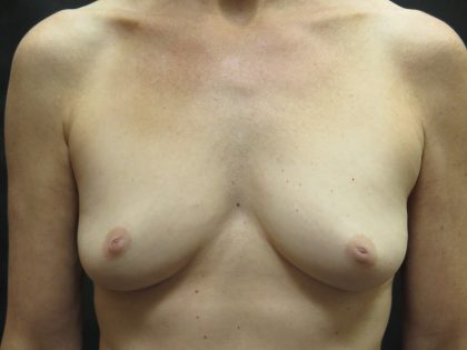 Inverted Nipple Correction Before & After Patient #1872