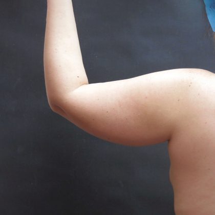 Liposuction Before & After Patient #927