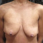 Breast Lift Before & After Patient #1244