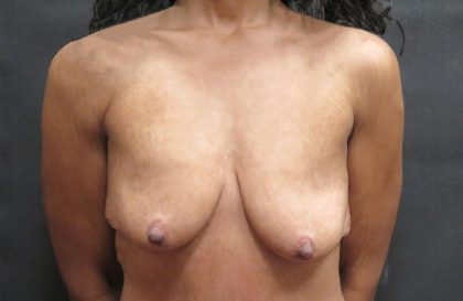 Breast Lift Before & After Patient #1244