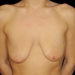 Breast Lift Before & After Patient #1212