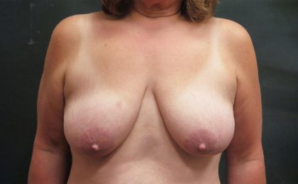 Breast Lift Before & After Patient #1223