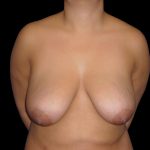 Breast Lift Before & After Patient #1166
