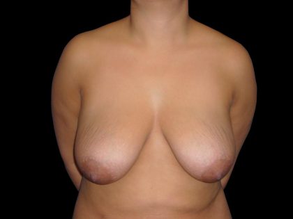 Breast Lift Before & After Patient #1166