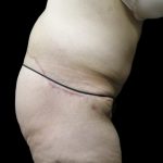 Lower Body Lift Before & After Patient #2305