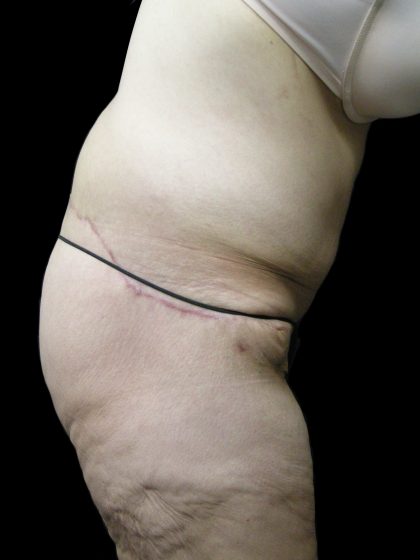 Lower Body Lift Before & After Patient #2305