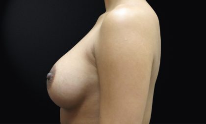 Breast Augmentation Before & After Patient #1161