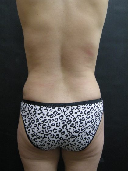 Mommy Makeover Before & After Patient #2657