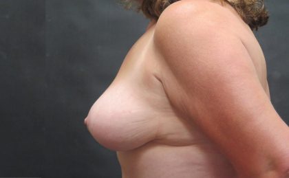 Breast Lift Before & After Patient #1223
