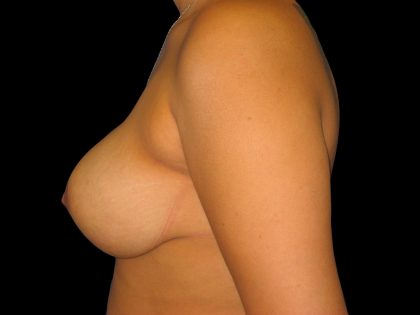 Breast Reduction Before & After Patient #1398