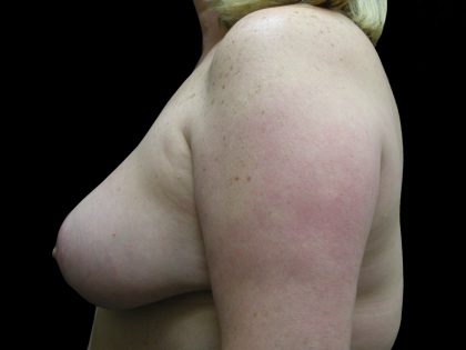 Breast Reduction Before & After Patient #1447
