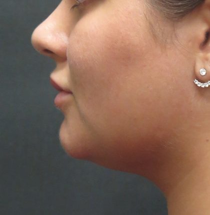 Scarless Facelift and Necklift Before & After Patient #3028