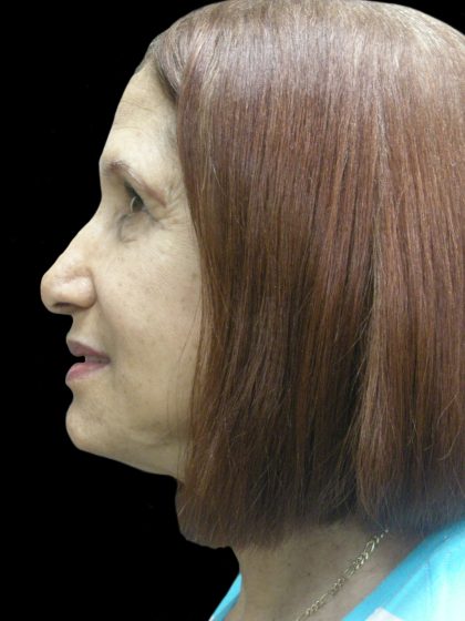 Fat Transfer Before & After Patient #1765