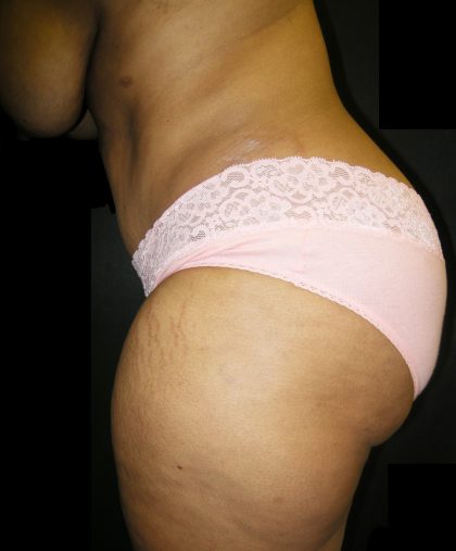 Tummy Tuck Before & After Patient #3166