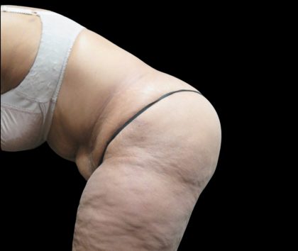 Tummy Tuck Before & After Patient #3209