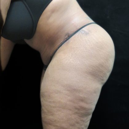 Tummy Tuck Before & After Patient #3267