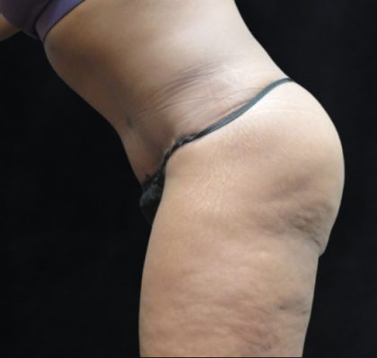 Tummy Tuck Before & After Patient #3387