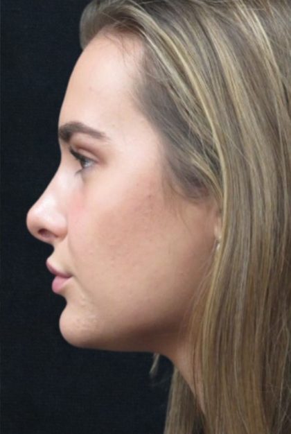 Rhinoplasty Before & After Patient #2926