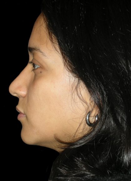 Rhinoplasty Before & After Patient #2905