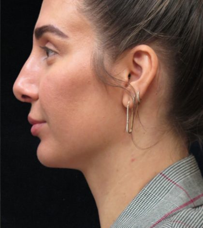 Rhinoplasty Before & After Patient #2851