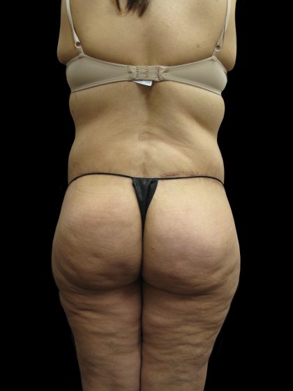 Post Weight Loss Before & After Patient #2791