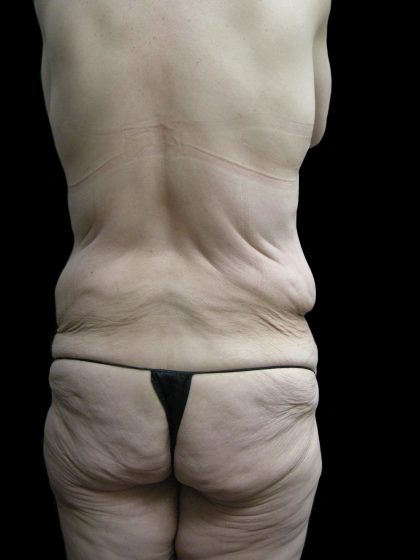 Post Weight Loss Before & After Patient #2770