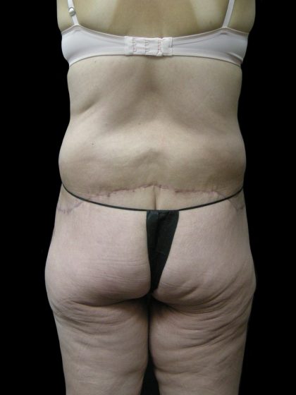 Lower Body Lift Before & After Patient #2305