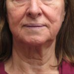 Facelift Before & After Patient #1639