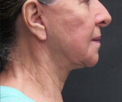 Facelift Before & After Patient #1639