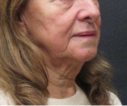Facelift Before & After Patient #1639