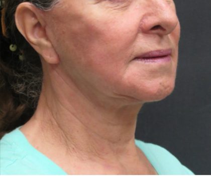Facelift Before & After Patient #1639