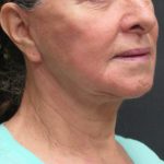 Facelift Before & After Patient #1639